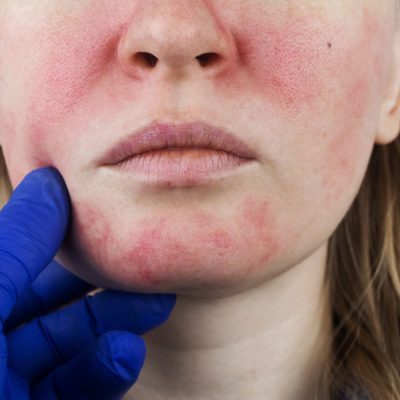 Living with Rosacea: Navigating the Challenges and Finding Relief